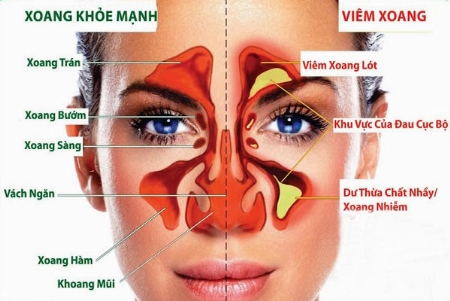 Viêm xoang sàng ở trẻ em