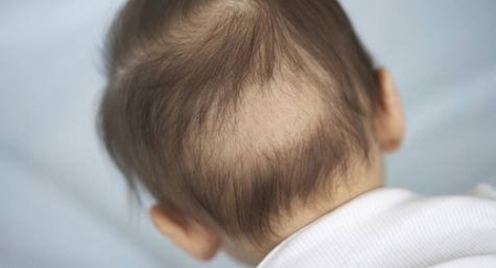 Cần biết về hiện tượng rụng tóc ở trẻ sơ sinh