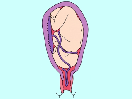 Cách phòng ngừa sa dây rốn trong thai kỳ