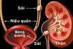 Thiếu canxi, uống ít nước dễ dẫn đến sỏi thận