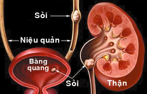 Thiếu canxi, uống ít nước dễ dẫn đến sỏi thận