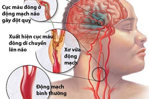 Cảnh báo những cái chết do đột quỵ ở người trẻ