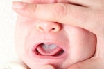 Cách chữa tưa lưỡi ở trẻ sơ sinh và trẻ nhỏ